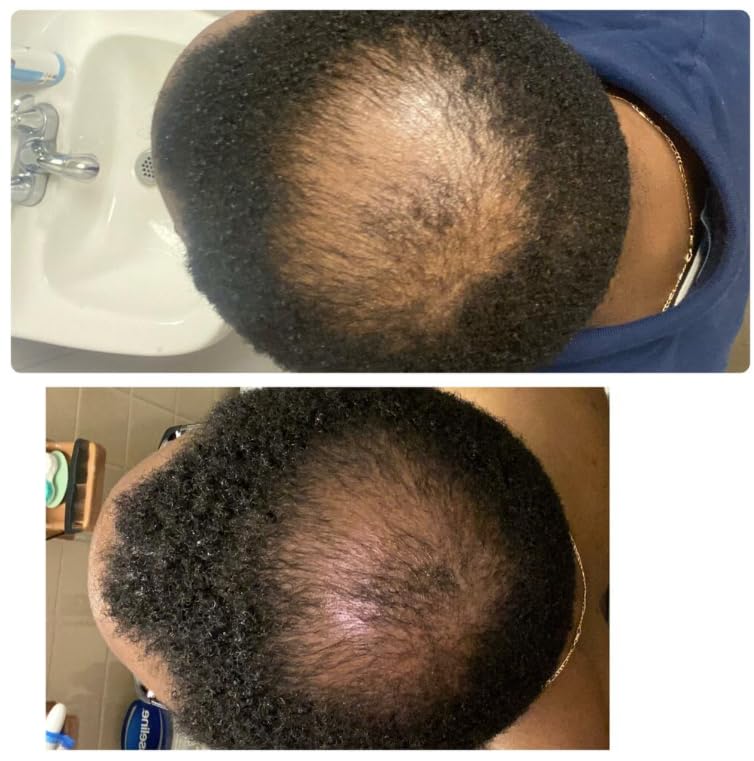 Kreyol Essence - Scalp Care POMAD, Detox + Treat, Rosemary Peppermint 4 Oz, Natural, Paraben Free, Healthy Scalp, Hair Care